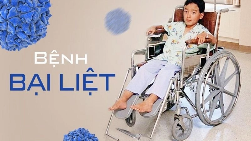 Triệu chứng của bệnh bại liệt là gì và dễ nhận biết không?
