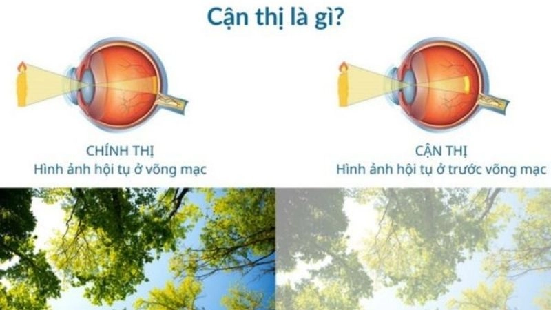 Tại sao cận thị ngày càng phổ biến ở giới trẻ hiện nay?