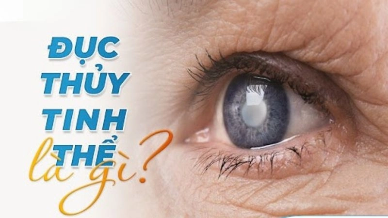 Làm thế nào để phòng ngừa đục thủy tinh thể hiệu quả?