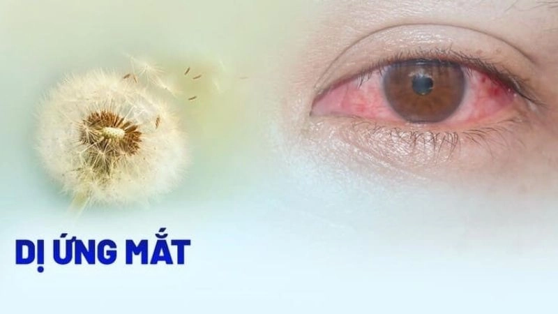 Dị ứng mắt (eye allergy) là tình trạng xảy ra khi mắt tiếp xúc với các chất gây kích ứng
