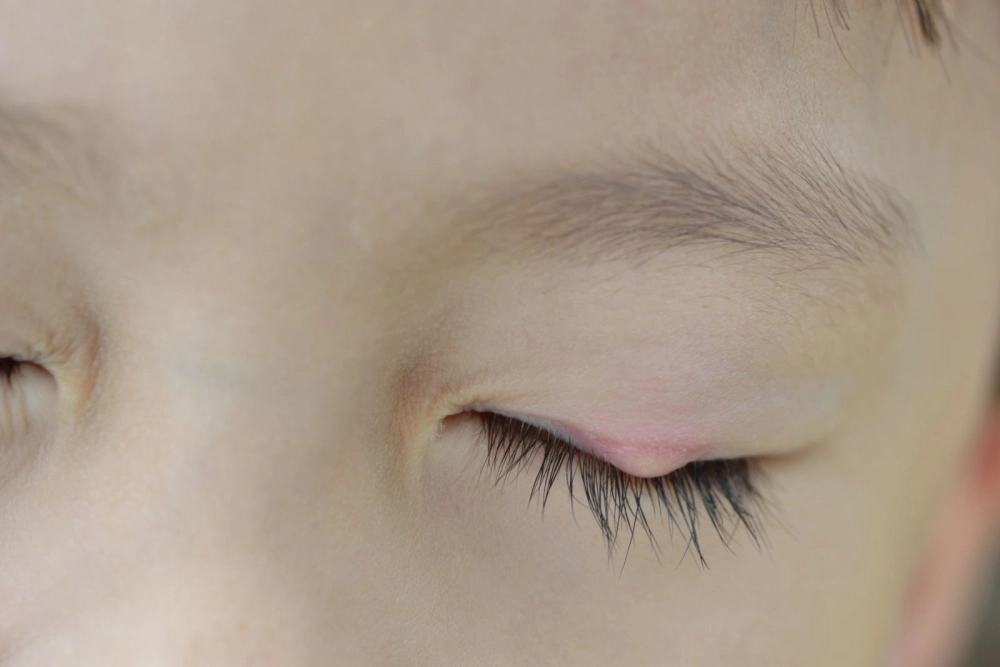 Viêm bờ mi gây khó chịu và ngứa rát mắt