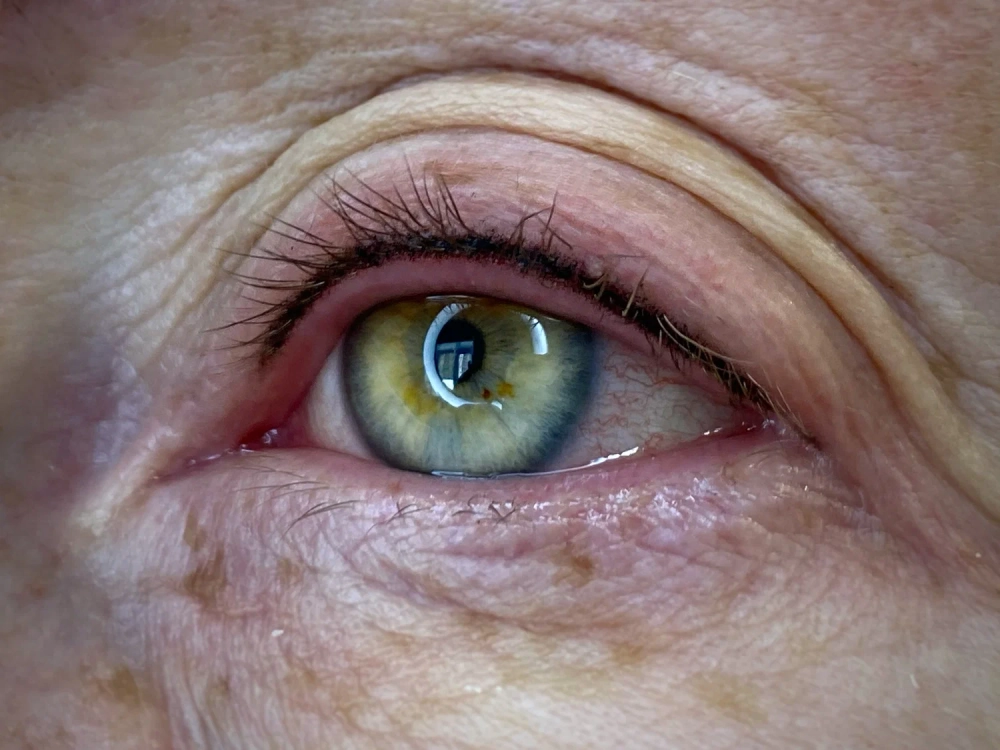 Nguyên nhân viêm bờ mi liên quan vi khuẩn bụi bẩn