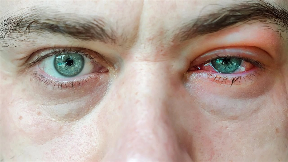 Viêm bờ mi mắt ảnh hưởng sinh hoạt hằng ngày