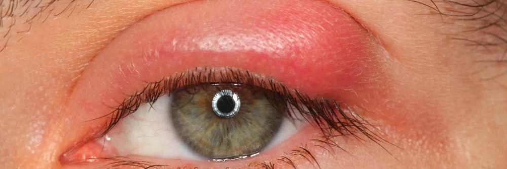 Viêm bờ mi mãn tính gây dai dẳng kéo dài