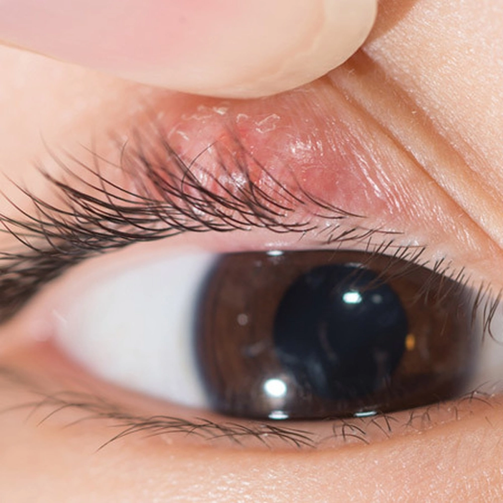 Viêm bờ mi là gì vấn đề mắt thường gặp