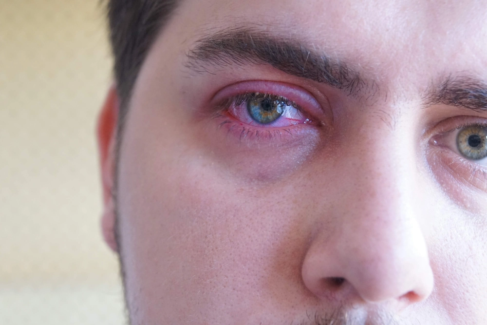 Viêm bờ mi có khỏi không phụ thuộc điều trị