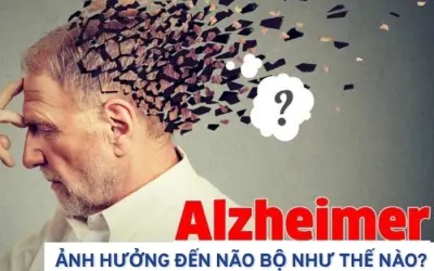 Bệnh Alzheimer ảnh hưởng đến não bộ ra sao?