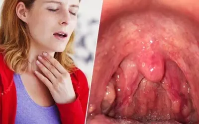 Viêm họng do nguyên nhân gì? Bác sĩ tiết lộ sự thật