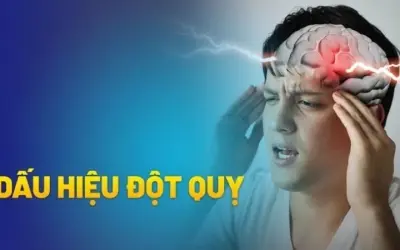 Làm thế nào để nhận biết dấu hiệu đột quỵ kịp thời?