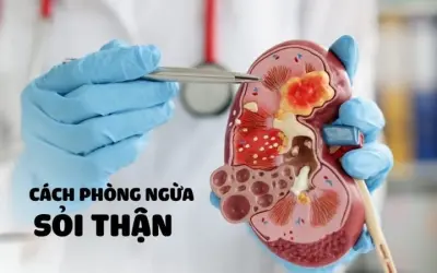 Triệu chứng của bệnh sỏi thận là gì? Đừng xem nhẹ