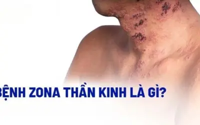 Zona thần kinh có triệu chứng gì và nhận biết ra sao?