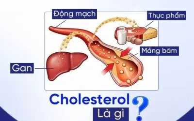Cholesterol cao tác động gì đến hệ tim mạch con người?