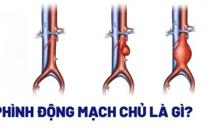 Triệu chứng cảnh báo phình động mạch chủ nguy hiểm