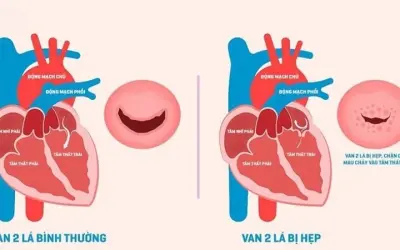 Các phương pháp điều trị van tim phổ biến hiện nay