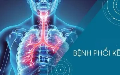 Điều trị bệnh phổi kẽ - Giải pháp nào là tối ưu nhất?