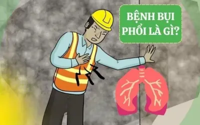 Triệu chứng của bệnh bụi phổi là gì và dấu hiệu cảnh báo