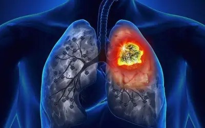 Triệu chứng ban đầu của ung thư phổi dễ bị bỏ qua