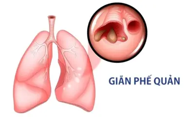 Triệu chứng của bệnh giãn phế quản nguy hiểm dễ bị bỏ qua