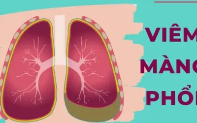Viêm màng phổi có triệu chứng gì và cách nhận biết sớm?