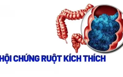 Triệu chứng của hội chứng ruột kích thích IBS là gì?