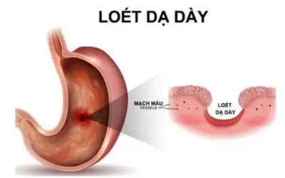 Làm sao để bảo vệ dạ dày khỏi tình trạng loét kéo dài?