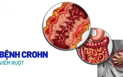 Bệnh Crohn được điều trị như thế nào và trong bao lâu?