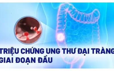 Triệu chứng ung thư đại tràng bạn không nên chủ quan