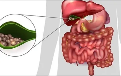 Thói quen nào giúp ngừa sỏi mật và bảo vệ hệ tiêu hóa?