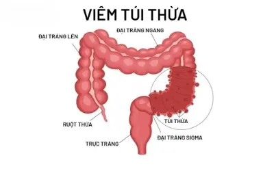 Viêm túi thừa - Triệu chứng thầm lặng cần nhận diện sớm