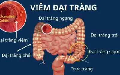 Triệu chứng của viêm loét đại tràng là gì? Dấu hiệu cảnh báo
