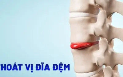 Triệu chứng của thoát vị đĩa đệm là gì và nguy hiểm thế nào