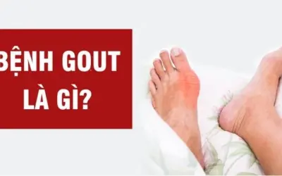 Bệnh gút do nguyên nhân gì? Cách điều trị và phòng ngừa