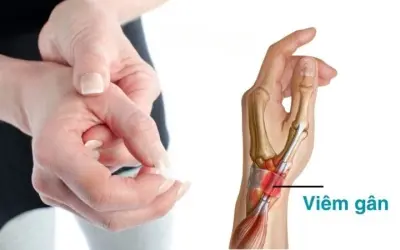 Triệu chứng của viêm gân là gì? Đừng bỏ qua dấu hiệu này