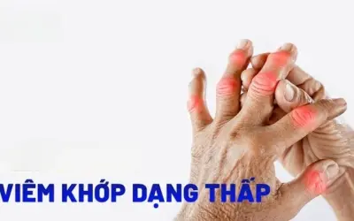 Bệnh viêm khớp dạng thấp được điều trị như thế nào?
