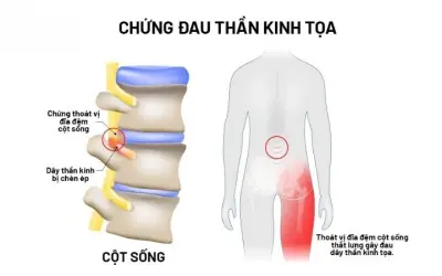 Tại sao đau dây thần kinh tọa gây đau lưng dữ dội?
