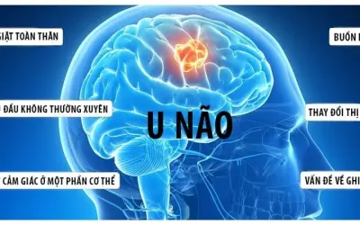 Những triệu chứng đầu tiên cảnh báo bệnh u não nguy hiểm