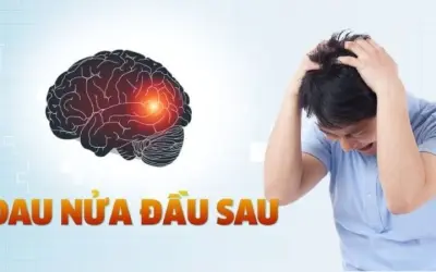 Làm thế nào để điều trị đau nửa đầu hiệu quả và an toàn?