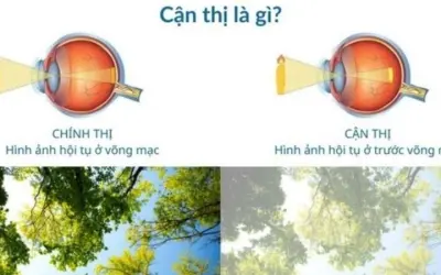 Tại sao cận thị ngày càng phổ biến ở giới trẻ hiện nay?