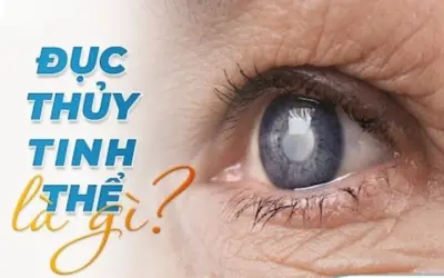 Làm thế nào để phòng ngừa đục thủy tinh thể hiệu quả?