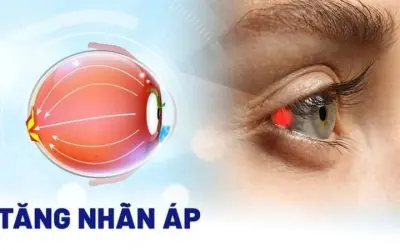 Tăng nhãn áp là gì? Triệu chứng cảnh báo cần lưu ý