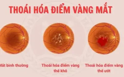 Bệnh thoái hóa điểm vàng là gì? Triệu chứng dễ bị bỏ qua