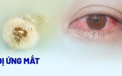 Mắt đỏ vì dị ứng - Nguyên nhân tiềm ẩn và cách chăm sóc đúng
