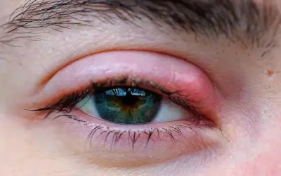 Làm thế nào để điều trị viêm bờ mi an toàn theo chuyên gia