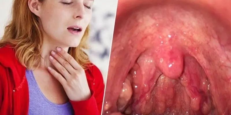 Viêm họng do nguyên nhân gì? Bác sĩ tiết lộ sự thật