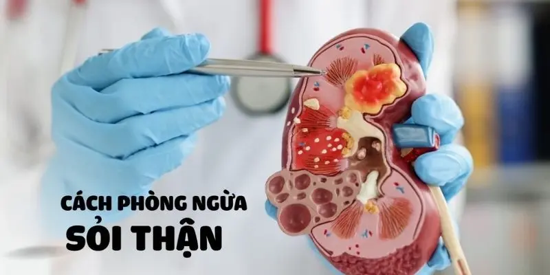 Triệu chứng của bệnh sỏi thận là gì? Đừng xem nhẹ