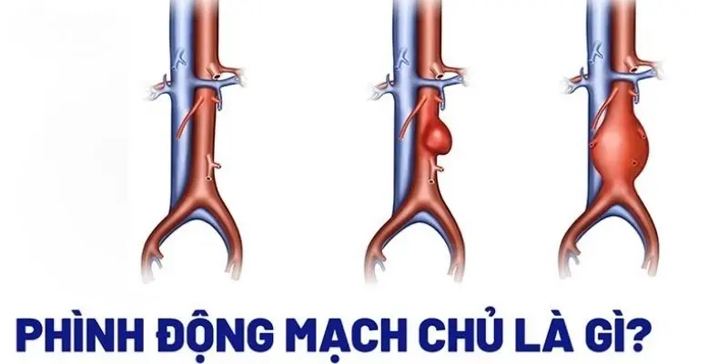 Triệu chứng cảnh báo phình động mạch chủ nguy hiểm