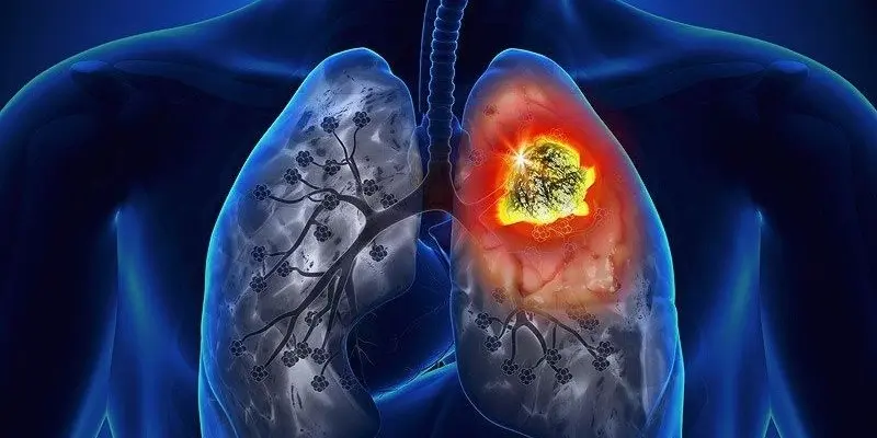 Triệu chứng ban đầu của ung thư phổi dễ bị bỏ qua