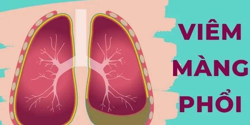 Viêm màng phổi có triệu chứng gì và cách nhận biết sớm?