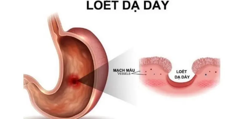 Làm sao để bảo vệ dạ dày khỏi tình trạng loét kéo dài?