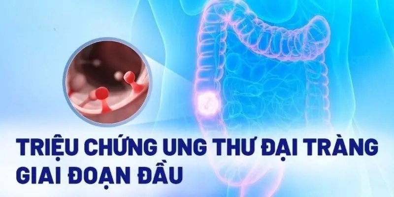 Triệu chứng ung thư đại tràng bạn không nên chủ quan